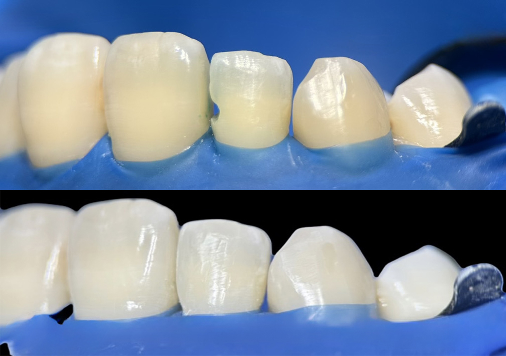 ダイレクトボンディングのメリット・デメリット