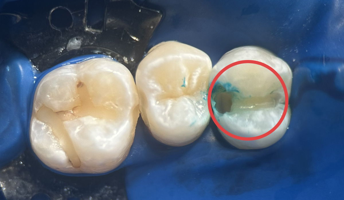case3 虫歯を削った写真