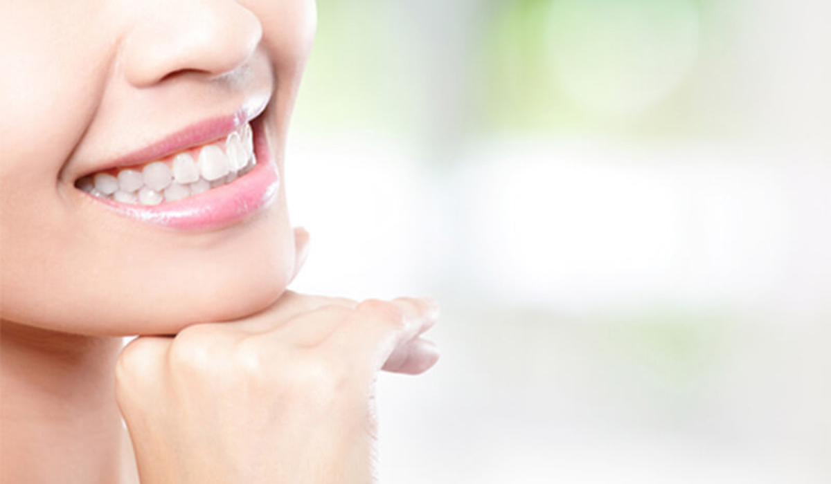 ラミネートべニアは前歯の見た目を改善する