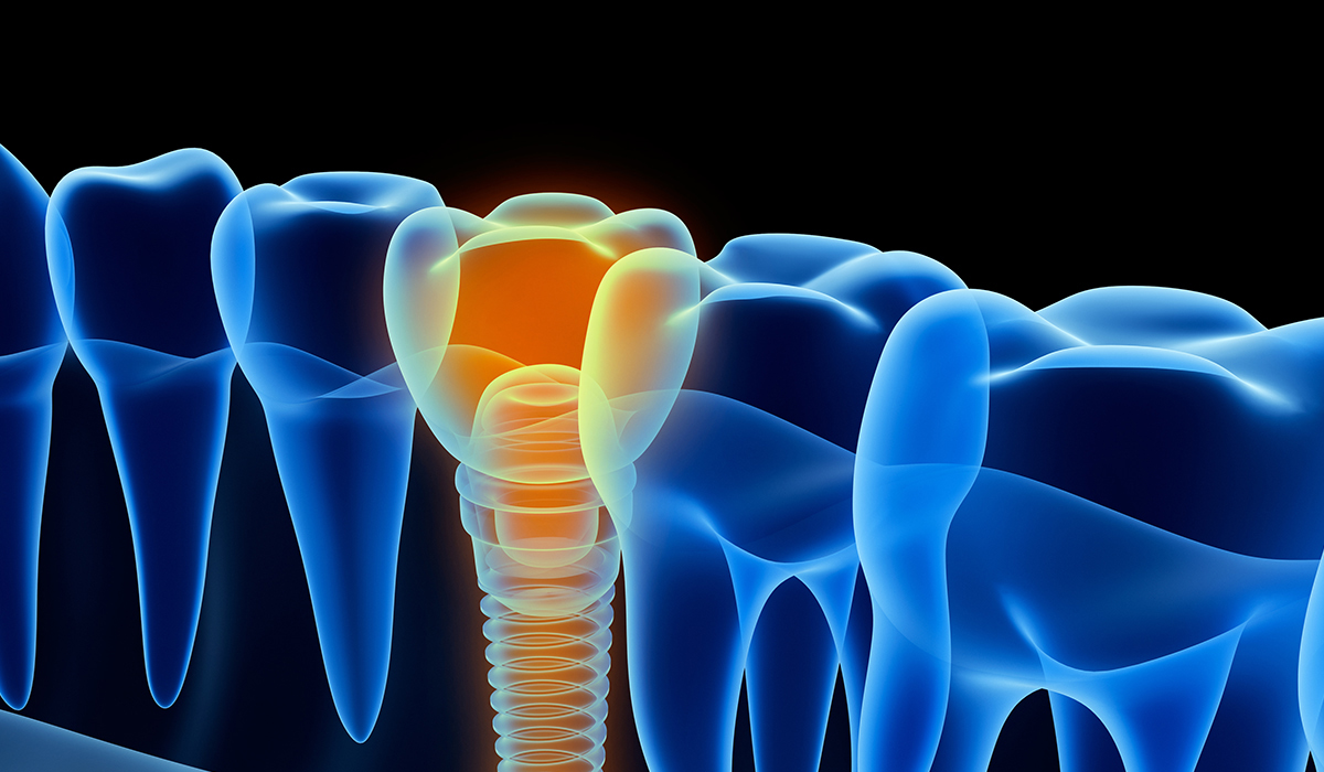 奥歯のインプラントは難しい？